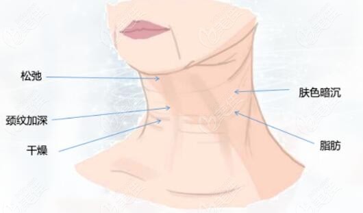 頸部皮膚松弛可以拉皮嗎