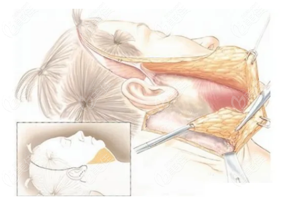 拉皮手术副作用有哪些太可怕了