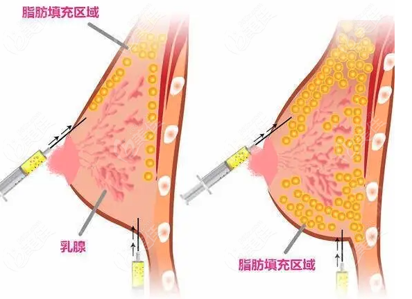 上海十大自体脂肪隆胸医院排名公示