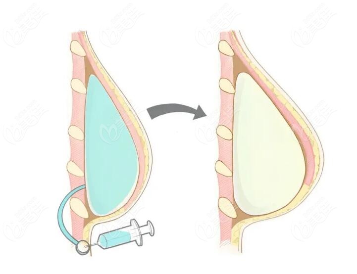 哈尔滨乳房再造医院哪家好,排名上有做乳房二次重建好价格不高的医院