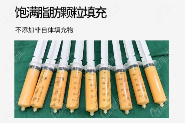 冯斌医生脂肪填充技术优势
