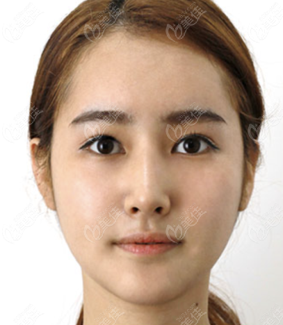 韩国Faceplus做面部轮廓嘴巴没歪挺自然,这有面部轮廓前后对比照