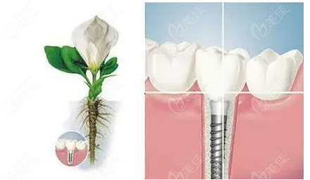 种植牙示意图