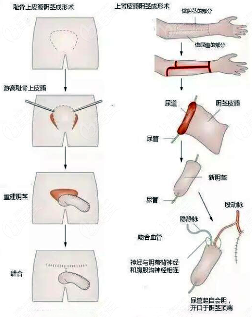变性手术过程图示
