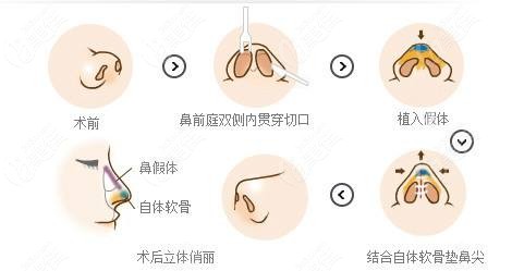 赤峰锦然整形做鼻综合的原理图
