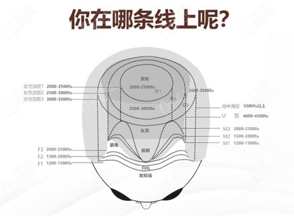 女生发际线植发要多少毛囊