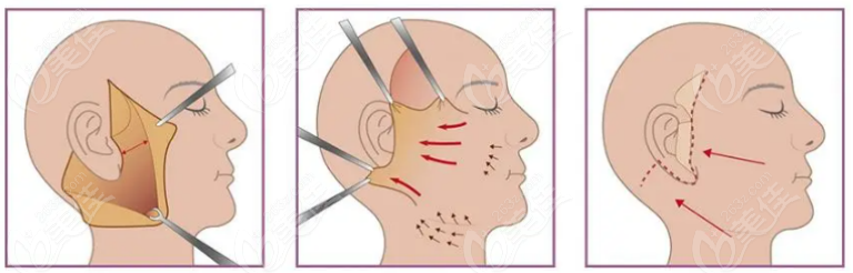 張林宏醫(yī)生拉皮