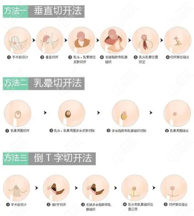 www.236z.com洛阳缩胸手术医院排名