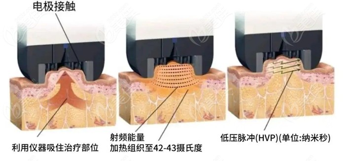 钻石超塑吸脂原理m.236z.com