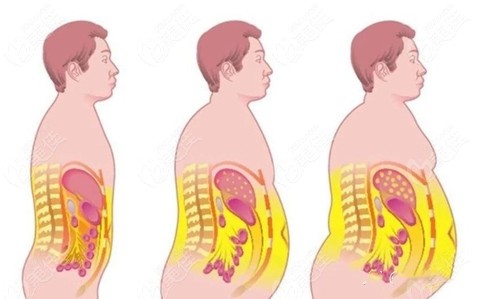 啤酒肚怎么瘦下來(lái)