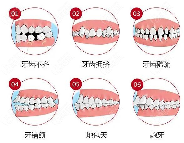 在北京通州牙齿矫正大约要多少钱