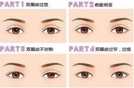 青海做雙眼皮失敗修復(fù)價(jià)格不同