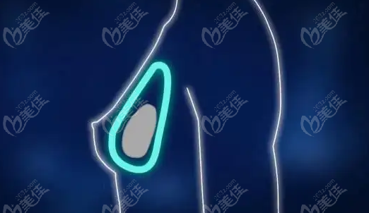 水滴形假体隆胸术后图~美佳网