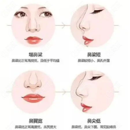 隆鼻失败修复类型