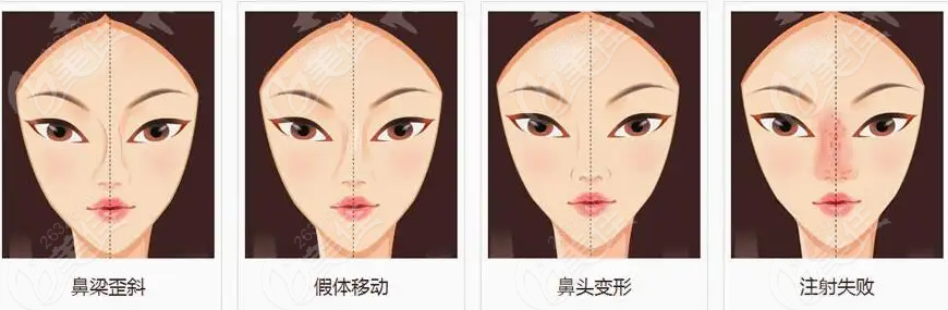 <!--<i data=20240703-sp></i>-->医生隆鼻修复类型多