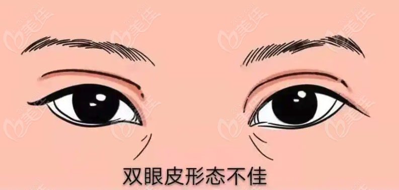 <!--<i data=20240703-sp></i>-->十大雙眼皮修復(fù)醫(yī)院排行榜