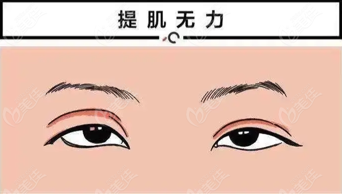 <!--<i data=20240703-sp></i>-->哪家醫(yī)院修復(fù)雙眼皮比較好