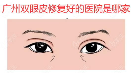 廣州做雙眼皮修復(fù)好的醫(yī)院排名