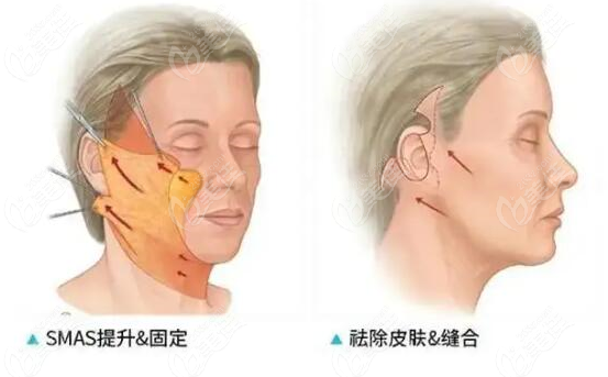 面部提升手術示意圖236z.com