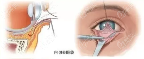 洛阳毛大夫去眼袋手术实例