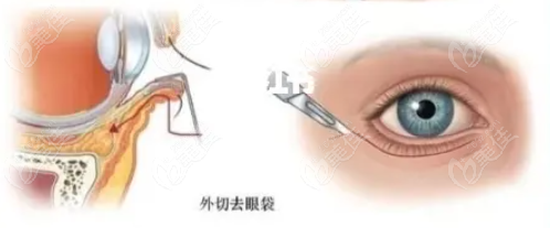 洛阳孔繁荣去眼袋实例展示