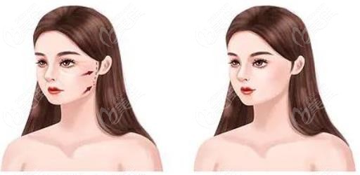 面部筋膜提升前后對比圖