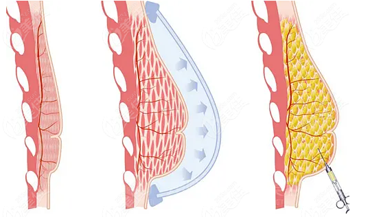 酒泉华美做脂肪丰胸手术 酒泉华美做脂肪丰胸手术
