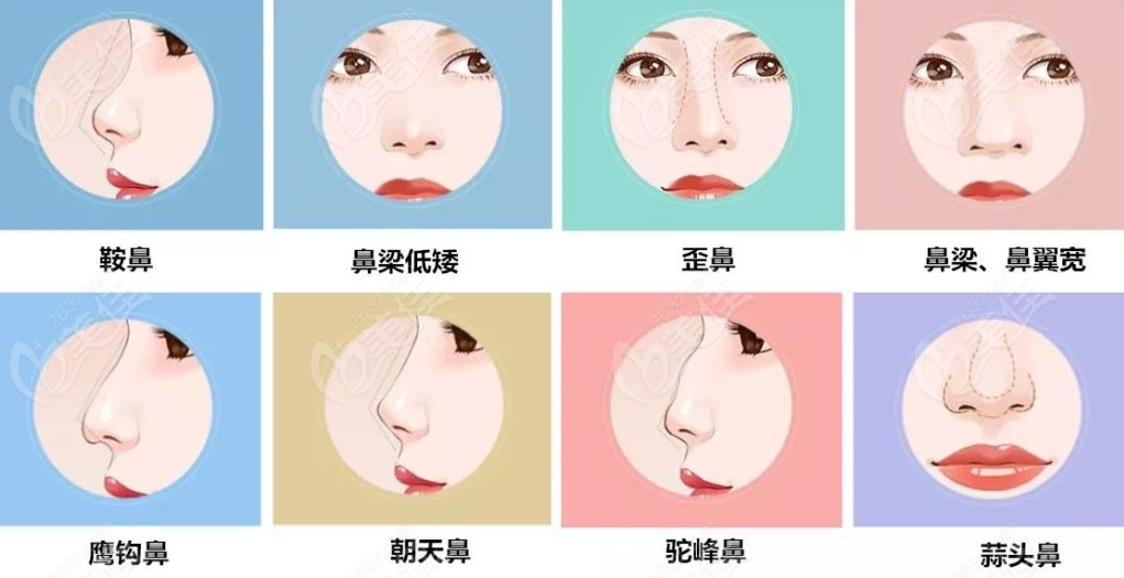武汉鼻综合技术医生可以改善鼻型