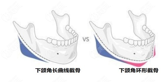 黄大勇下颌角切的不多留角风格自然美佳网