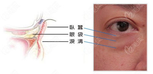 www.236z.com提供的眼袋手术剥离范围