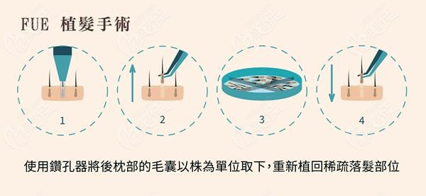 岳阳植发医院哪家比较好