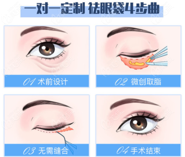 成都健丽医美去眼袋怎么样
