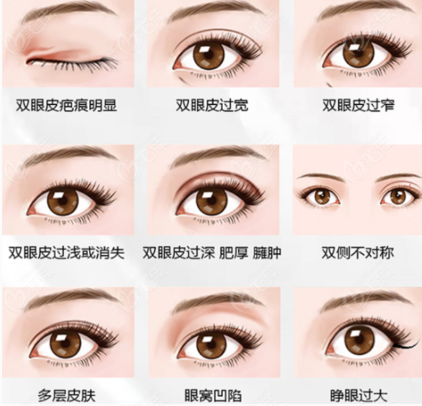 北京丽星翼美整形眼修复类型