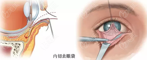 普通眼袋手术过程