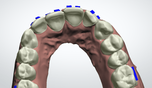 牙齿矫正方案模拟图
