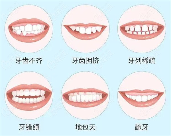 来看看哪些牙齿情况需要做牙齿矫正吧