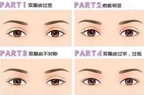 沈陽杏林修復(fù)雙眼皮多少錢