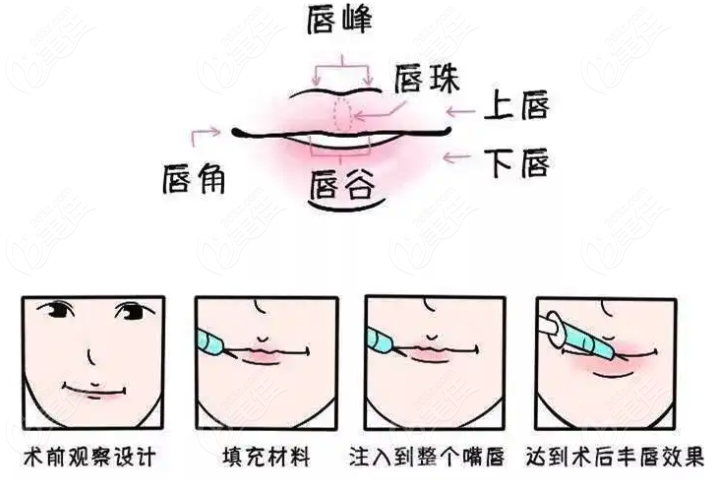 上海薇琳玻尿酸丰唇技术好