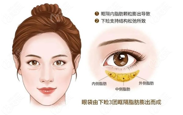 上海微创吸脂去眼袋手术价格多少钱