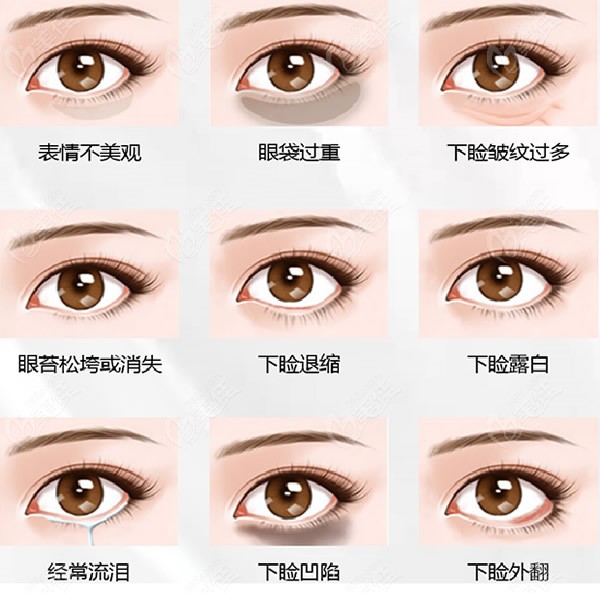 <!--<i data=20240703-sp></i>-->爱尚丽格杜园园眼袋修复怎么样