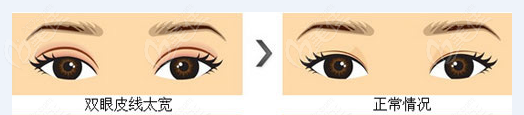 常州雙眼皮修復(fù)假寬深多少錢