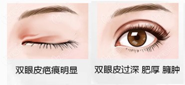 常州疤痕肉條眼修復(fù)價(jià)格
