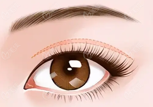 常州內(nèi)雙眼修復(fù)價(jià)格236z.com