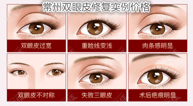 常州雙眼皮修復(fù)實(shí)例價(jià)格