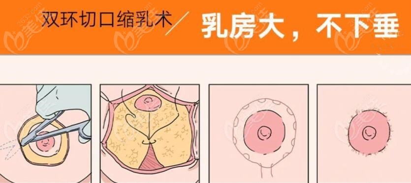 北京乳房缩小手术做得好的医院美佳网