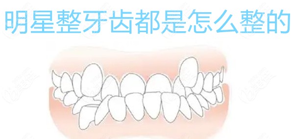 明星整牙齿都是怎么整的
