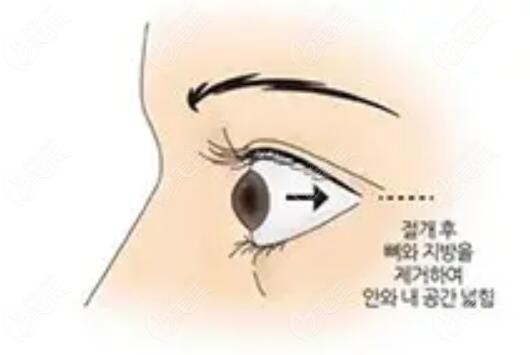 導致突眼的原因有哪些？