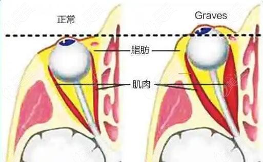 突眼矯正手術(shù)風險大嗎m.236z.com