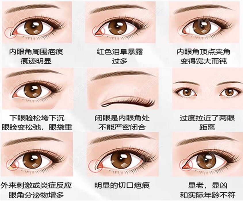 <!--<i data=20240703-sp></i>-->愛尚麗格杜園園醫(yī)生修復(fù)內(nèi)眼角類型