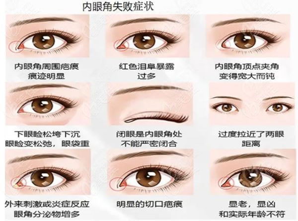 内眼角失败症状图片